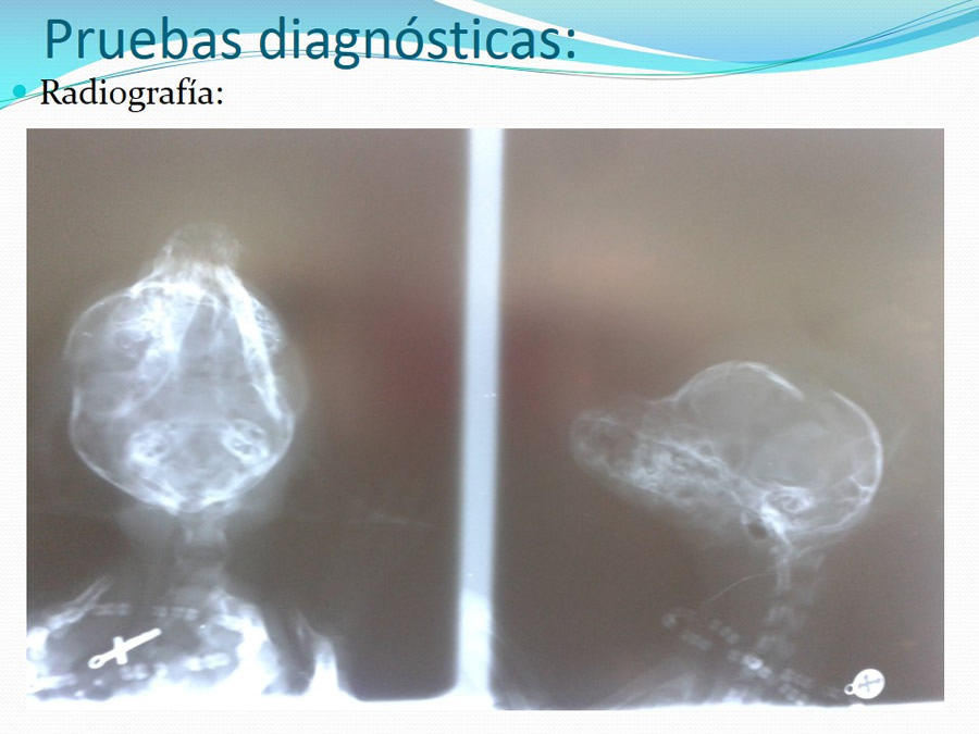 Fractura de la Bveda Craneal y Trauma Craneoenceflico